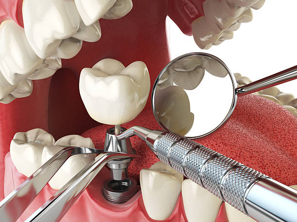 Best Emergency Root Canal Therapy in Burlingame, CA